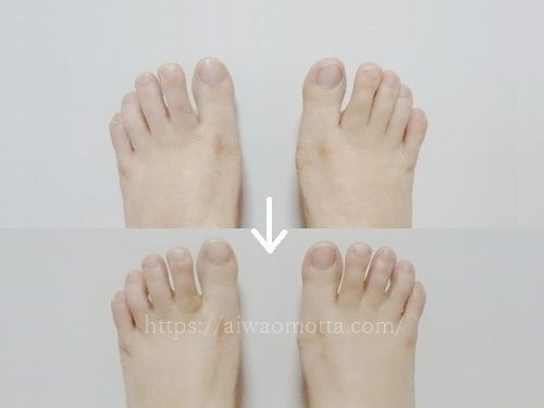 外反母趾の足の指を開いている比較画像