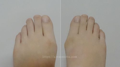 外反母趾の現在の足の画像